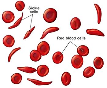 Avoid self-pity, consultant tells sickle cell patients