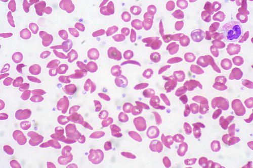 How sickle cell anaemia protects against malaria infection - Vanguard News