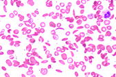 How sickle cell anaemia protects against malaria  infection