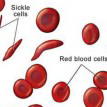 Sickle Cell Anemia: Expert warns intending couples over fake genotype results