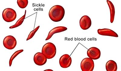 Stigmatisation against sickle-cell patients aggravates crisis by over 50% — Expert