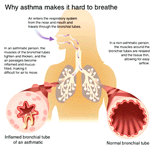 Foundation asks FG to position asthma as national priority disease