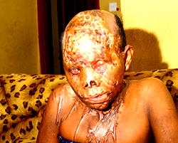 I saw death but God didn’t allow me to die – Paulina, woman bathed with acid by ex-lover