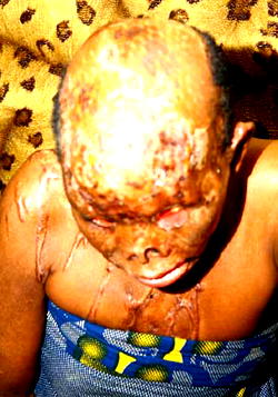 Jilted lover bathes ex-girlfriend with acid
