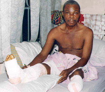Anukwu, amputated Luxury Bus driver gets help from NSITF