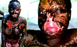 Undergraduate victim of acid bath cries out for help