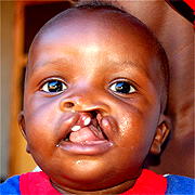 Cleft lip: HEWS puts smiles on their faces