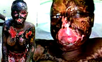 Lover-boy pours acid on fiancee