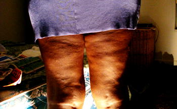 What you need to know about total knee replacement