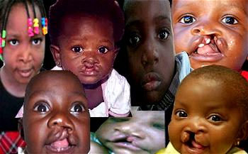 FG commences free surgical operations on 10,000 indigent children nationwide