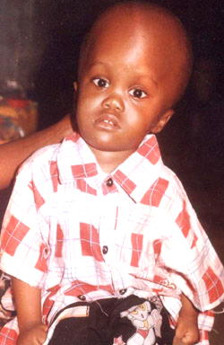 Baby Kehinde seeks N0.45m for hydrocephalus surgery