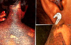 Scientists worry over paracetamol ‘skin rash’