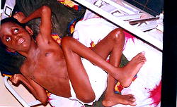 Prudence, a triplet, seeks N32m for corrective brain surgery