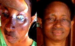 Succour to eye ailments patients in Delta, Edo