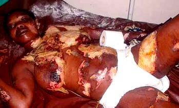 Latest on burnt housewife: Doctor frustrates NGOs, stops transfer for better treatment