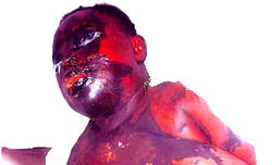 Jilted lover in police net over acid attack on girlfriend