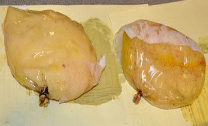 Woman implants cocaine in her breasts