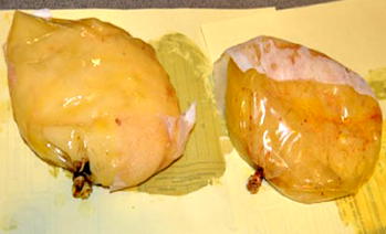 Woman implants cocaine in her breasts