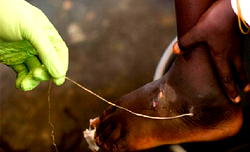What every Nigerian must know about Guinea worm
