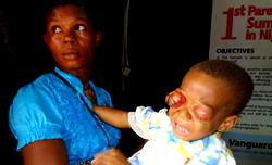 Agony of a 21-month old baby losing  both eyes