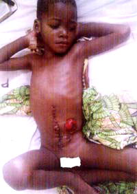 DOWN WITH BAD ANUS! 5-yr-old boy needs lifeline