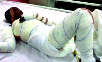 Woman sets 11-yr-old maid ablaze over piece of meat