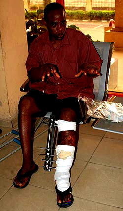 Artisan seeks N0.6m to treat broken leg