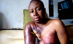 Radical Mastectomy for Nigeria now