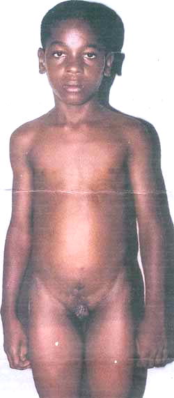 Boy, 13, has no reproductive organs