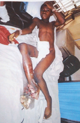 SUV crushes leg of 9-yr-old boy in        Lagos
