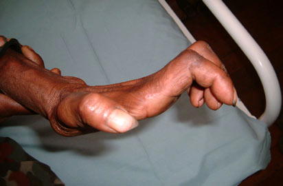 Anambra records 110 leprosy cases
