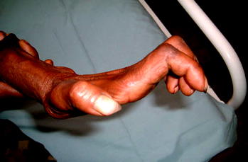 Anambra records 110 leprosy cases