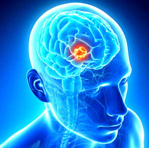 Stem cells loaded with herpes virus kill brain tumours