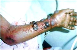 Facts to know about Ebola