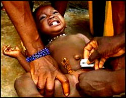 11  killed during botched circumcision in South Africa