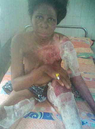 After mysterious fire: Family seeks N5m to settle medical bills