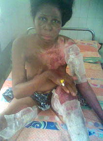 Fire incident: Family seeks N5m to settle medical bills