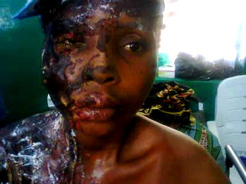 Don’t let me die, lady bathed with acid by ex-lover cries