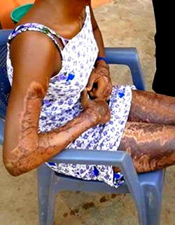 Man pours acid on girlfriend, says she is responsible for his illness