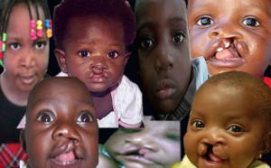 WACS trains 6 cleft care surgeons yearly