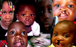 Obiano’s wife’s lifeline for children with cleft lips
