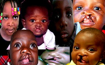 Obiano’s wife’s lifeline for children with cleft lips