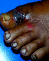 ‘For diabetic foot, prevention is better than cure’