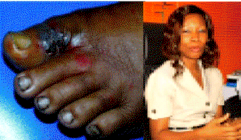 ‘For diabetic foot, prevention is better than cure’