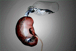 Expert links kidney diseases to untreated infections, others