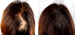 Going bald? Have a scalp tattoo, or hair transplant