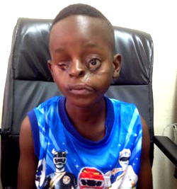 Boy, born with ‘divided face’, loses one eye