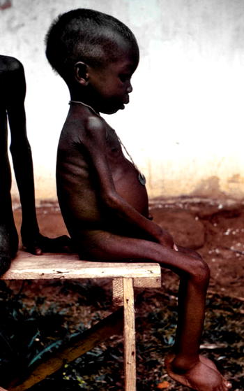 The ‘big man’ and the kwashiorkor child