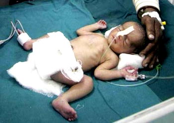 Man chops off 8-month-old baby’s  manhood during circumcision