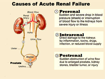 17,000 kidney failure cases diagnosed annually in Nigeria